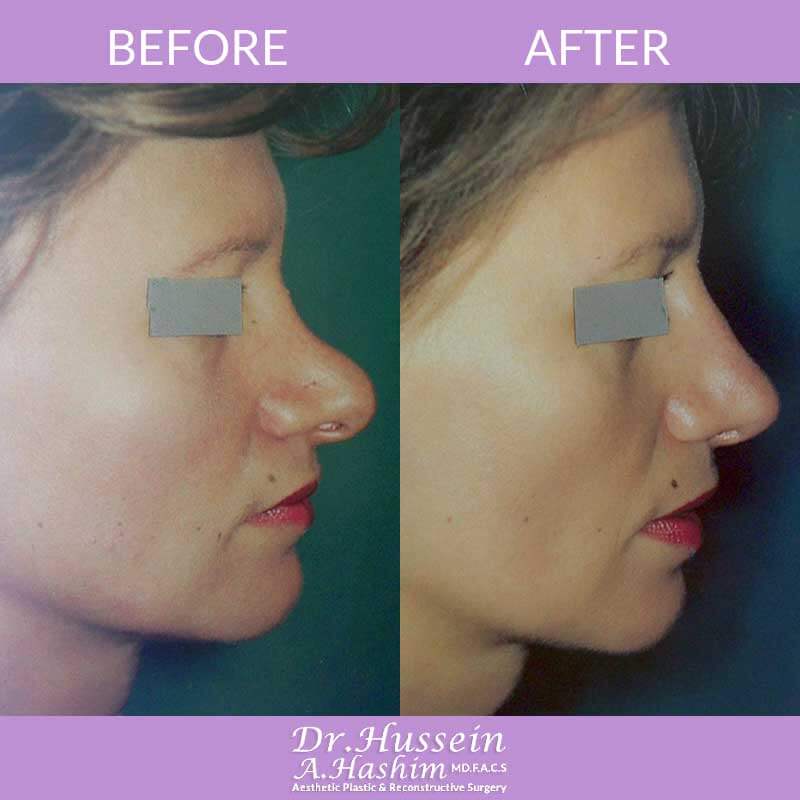 best-septorhinoplasty-surgeon-nose-job-before-after