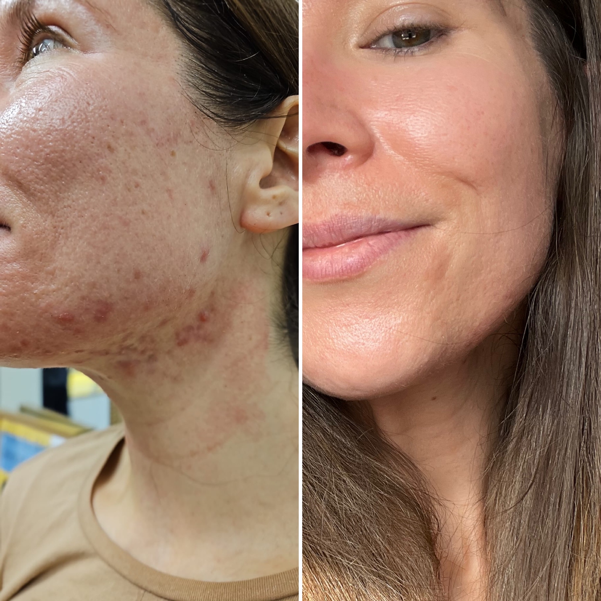 Adult acne treatment before and after photo of Danielle, in one image she has severe acne around her jawline and her pores are visible, the second she has clearer, more even-toned skin and is smiling